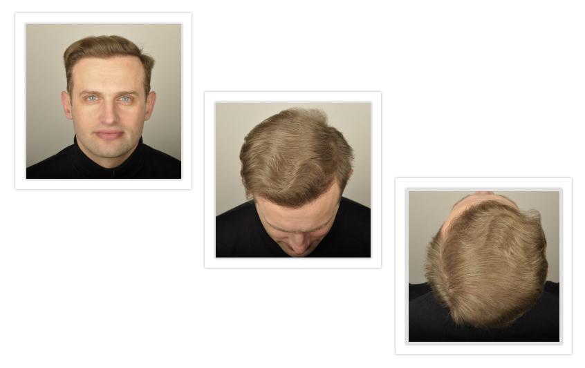 Hair Restoration & Replacement Brampton, Mississauga, Toronto, Oakville,  Burlington | Hair Forever